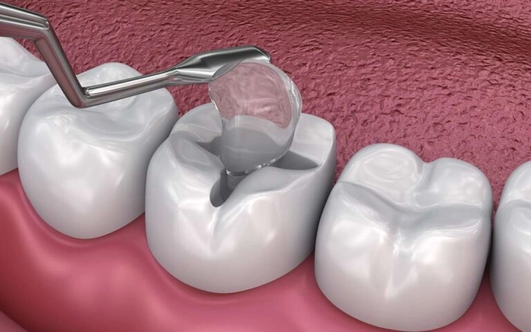 Dental-Fillings-768x480-1