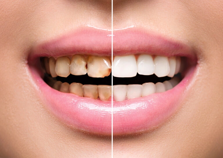 Teeth-Whitening-768x545-1