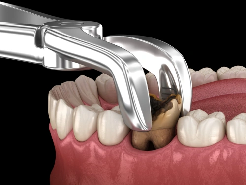 Tooth-Extraction
