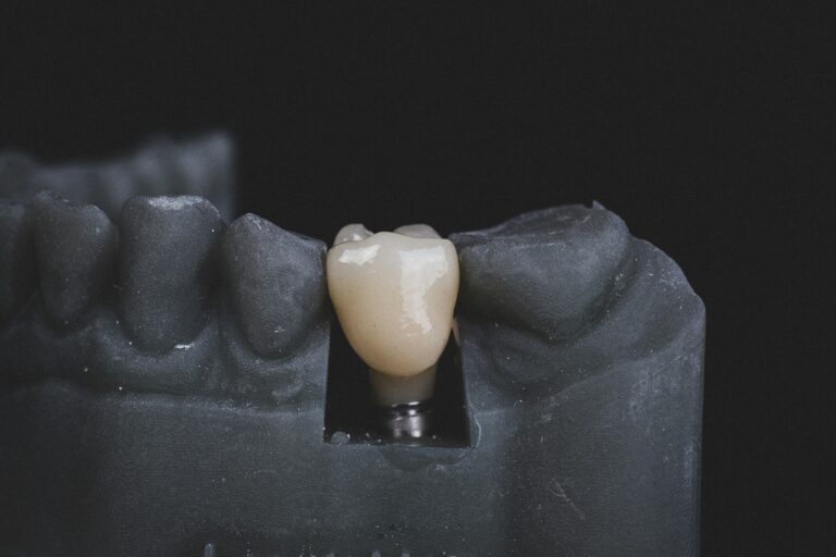Dental Implants in Gurgaon: Complete Smile Restoration Guide