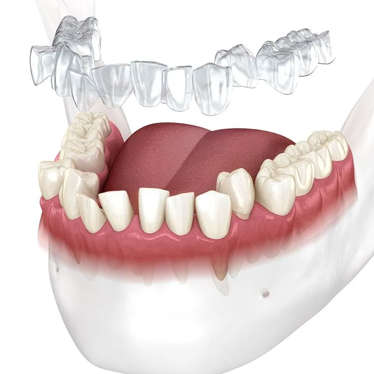 Best Braces & Invisalign Aligners in Gurgaon