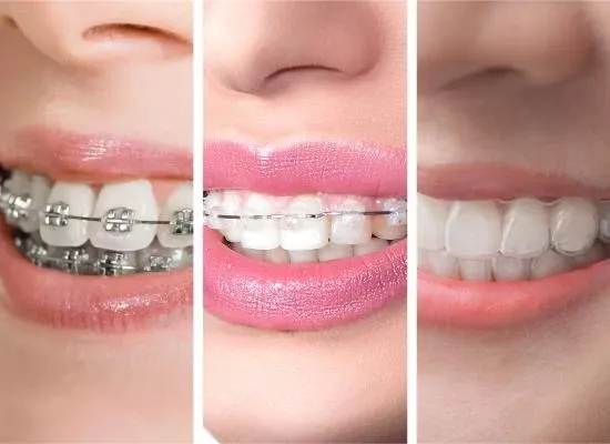 Best Braces & Invisalign Aligners in Gurgaon
